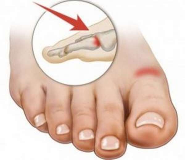 Травма пальца ноги